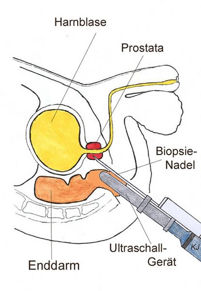 prostata knoten gutartig)
