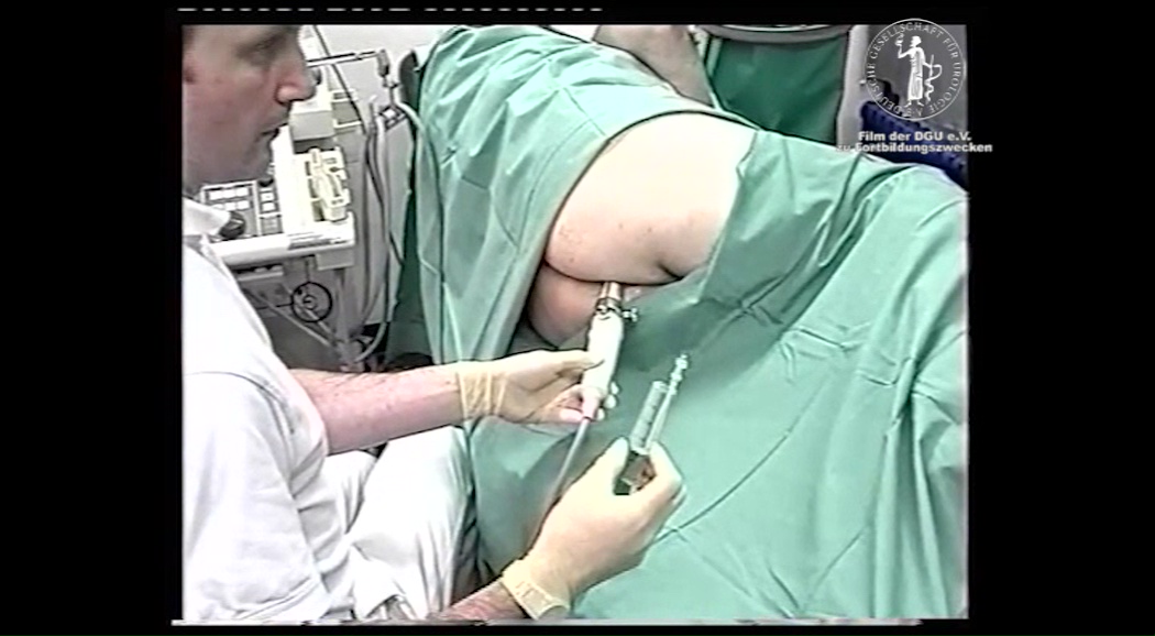 prostate biopsy video procedure)