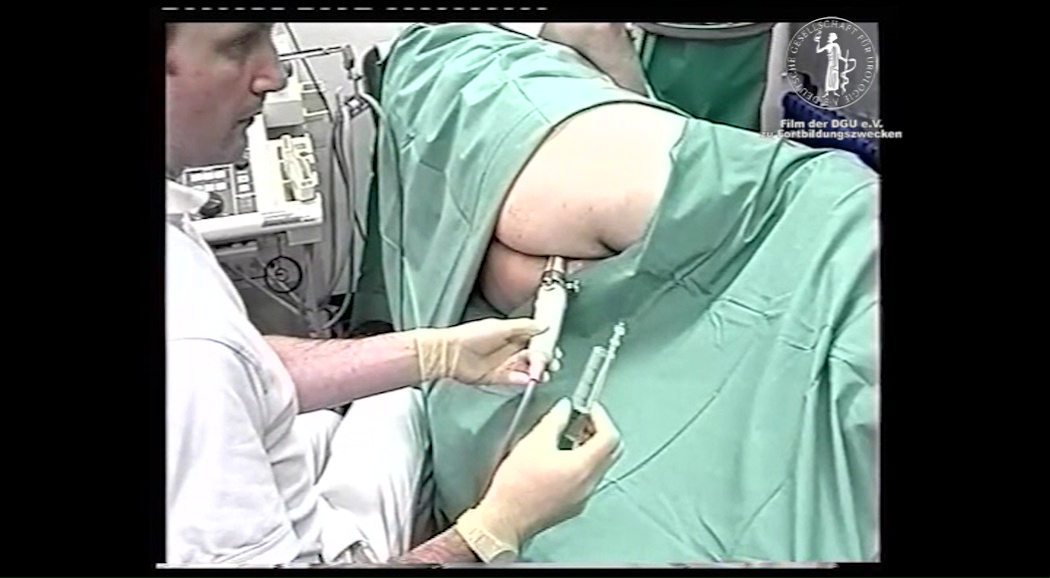 prostate biopsy video procedure